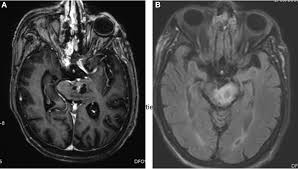 Trial failure shows value of tumor profiling in brainstem cancer treatment