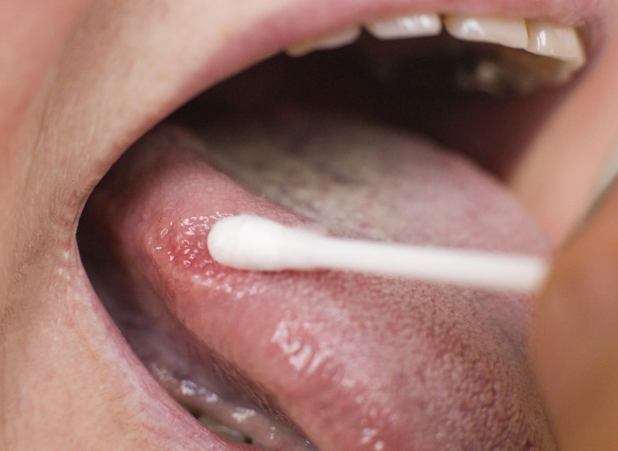 New $4 TB test gives results in 30 minutes using a tongue swab